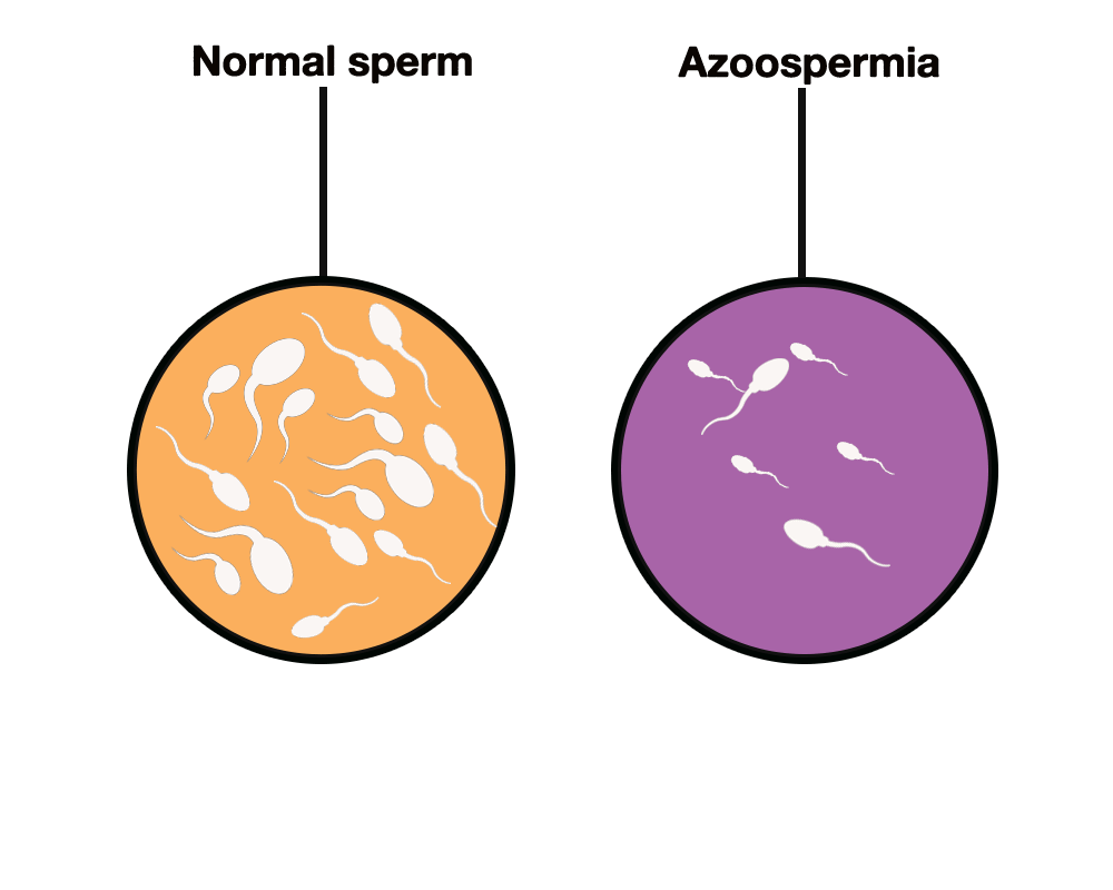 azoospermia surgery