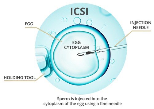 intracytoplasmic sperm injection icsi