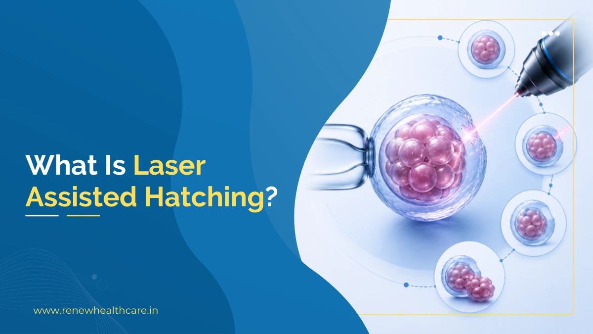 What Is Laser Assisted Hatching?