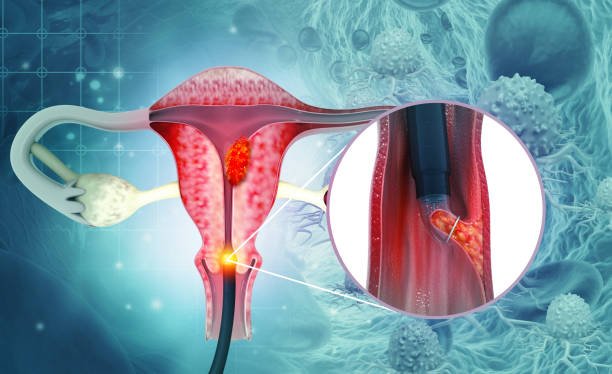 hysteroscopy test