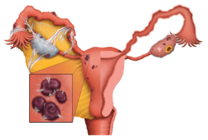 endometriosis symptoms