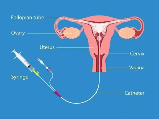 hysterosalpingography test