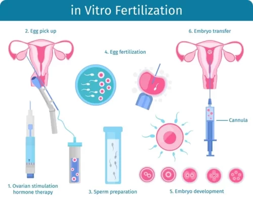 in Vitro fertilization process