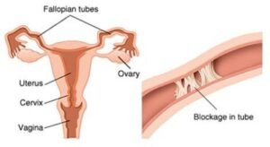 tubal blockage diagram