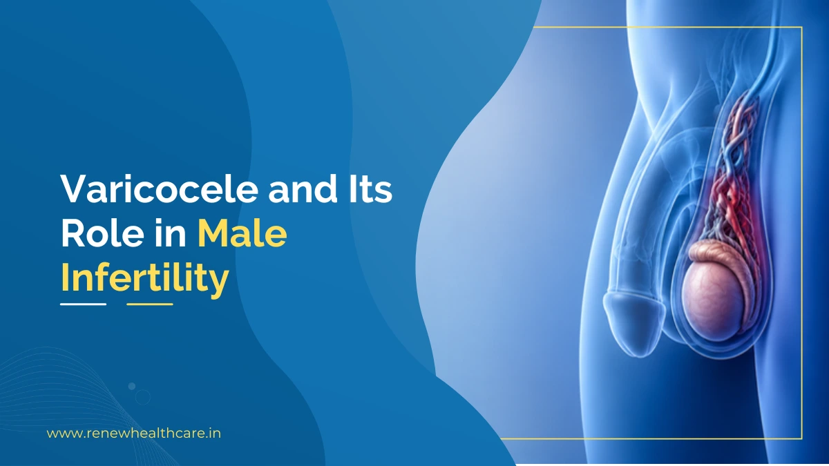 Varicocele and Its Role in Male Infertility