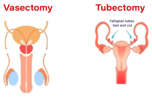 Laparoscopy procedure